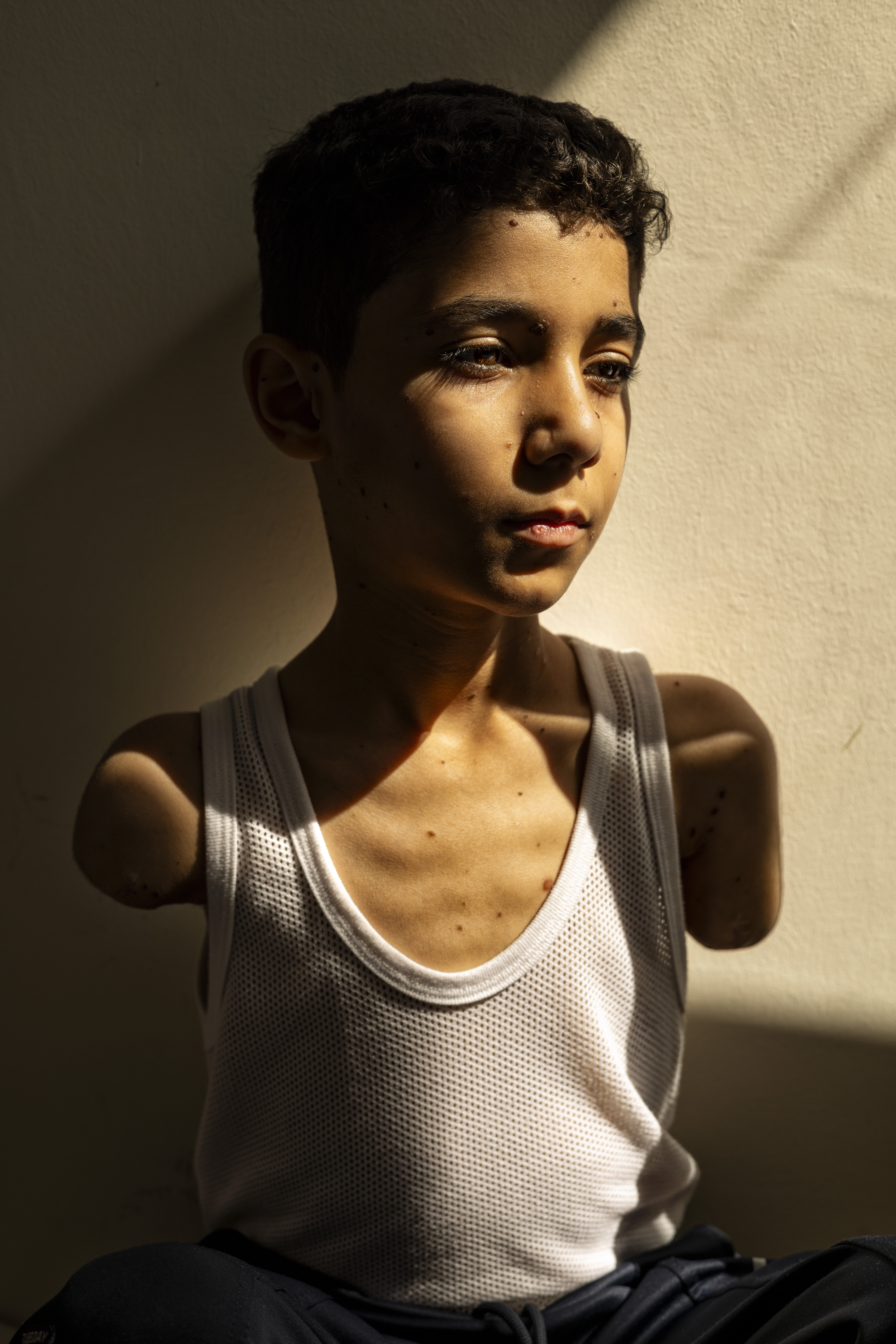 Der kleine Mahmoud Ajjour (9) verlor in Gaza beide Arme.